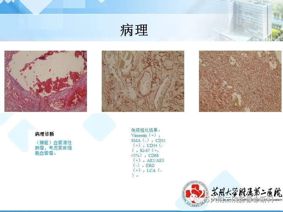 影像PPT - 【PPT】脾脏囊状淋巴管瘤 & 窦岸细胞血管瘤 & 硬化性血管瘤样结节转化-16