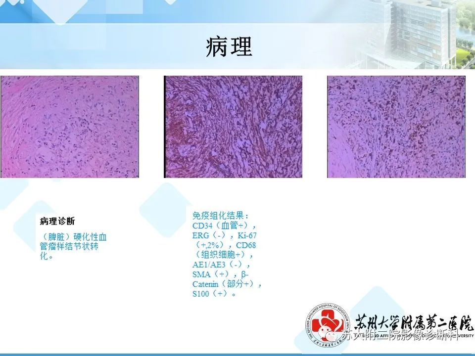 影像PPT - 【PPT】脾脏囊状淋巴管瘤 & 窦岸细胞血管瘤 & 硬化性血管瘤样结节转化-25