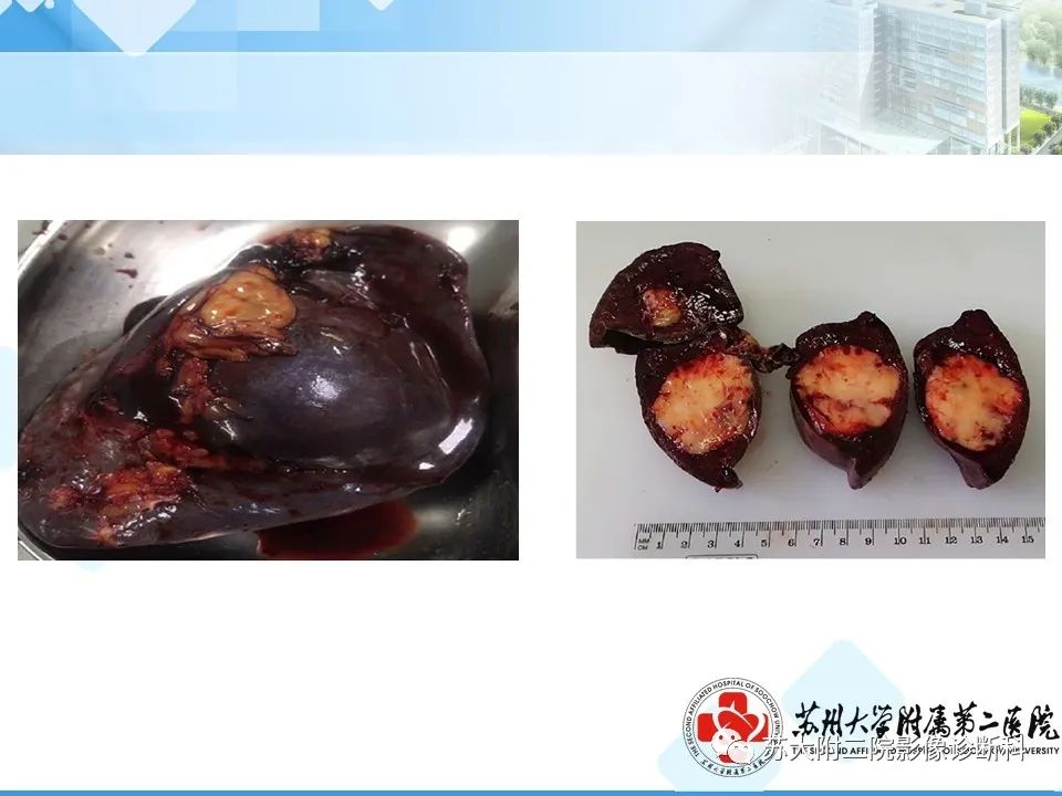影像PPT - 【PPT】脾脏囊状淋巴管瘤 & 窦岸细胞血管瘤 & 硬化性血管瘤样结节转化-28