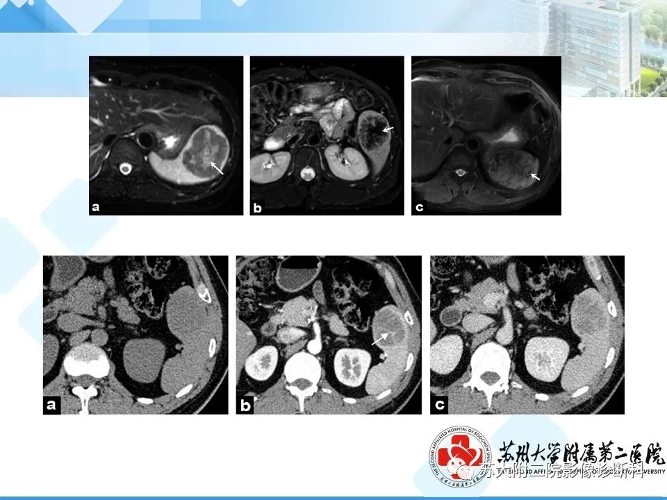 影像PPT - 【PPT】脾脏囊状淋巴管瘤 & 窦岸细胞血管瘤 & 硬化性血管瘤样结节转化-31