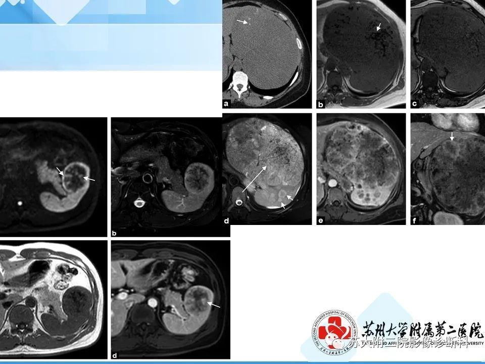 影像PPT - 【PPT】脾脏囊状淋巴管瘤 & 窦岸细胞血管瘤 & 硬化性血管瘤样结节转化-32