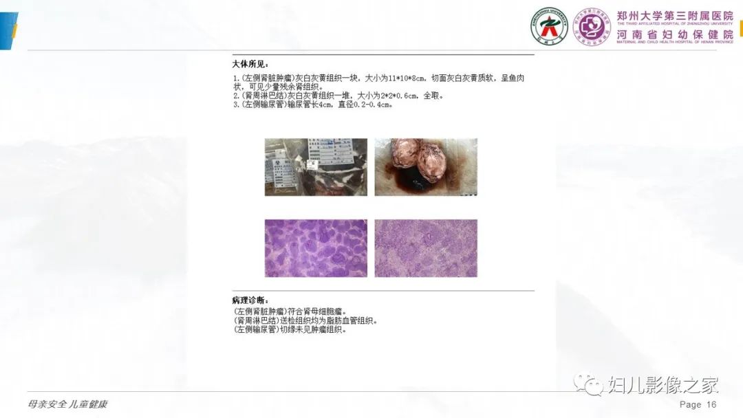 影像PPT - 【PPT】儿童肾母细胞瘤的影像诊断-15