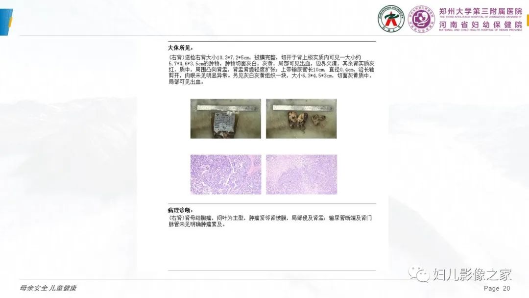 影像PPT - 【PPT】儿童肾母细胞瘤的影像诊断-19