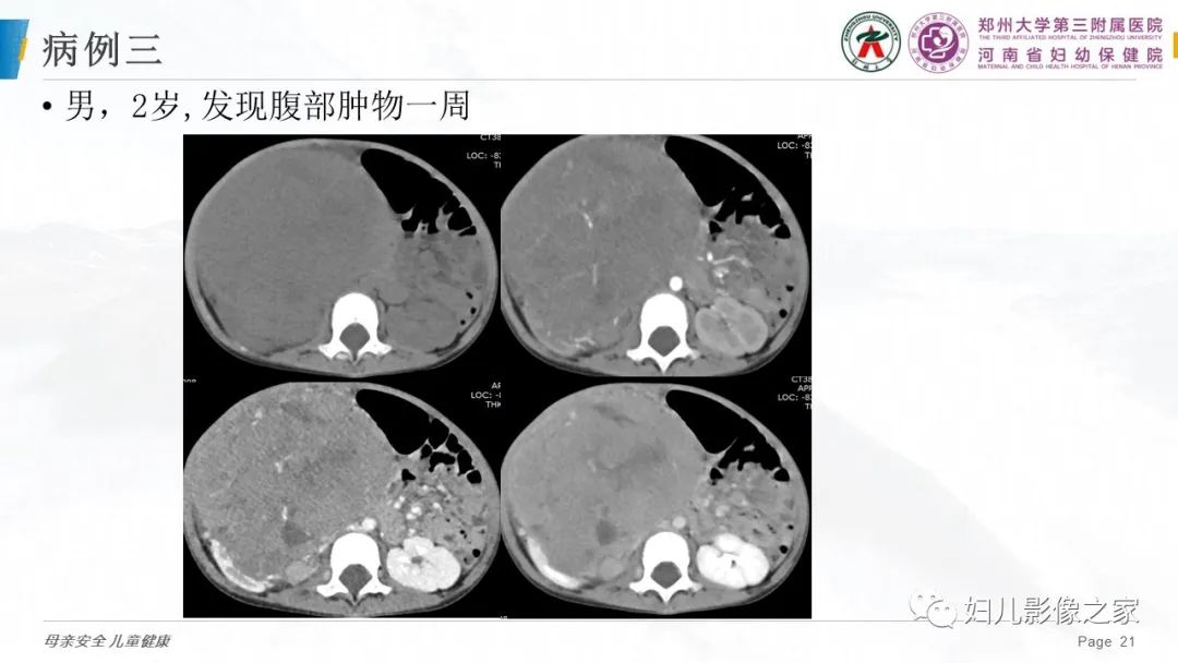 影像PPT - 【PPT】儿童肾母细胞瘤的影像诊断-20