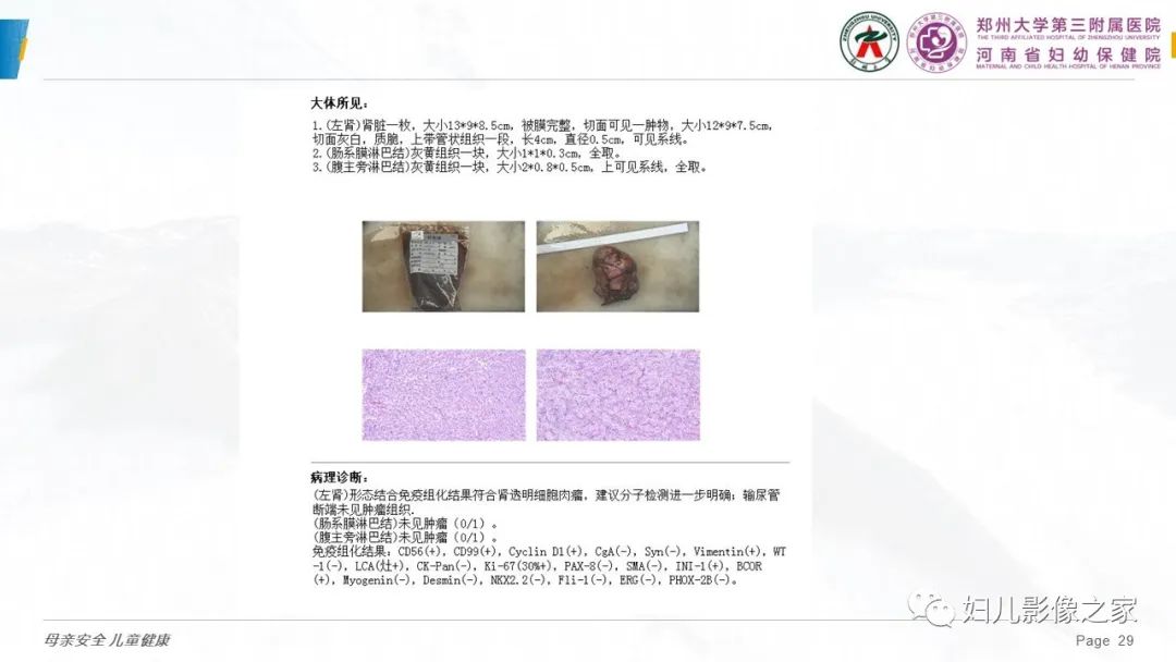 影像PPT - 【PPT】儿童肾母细胞瘤的影像诊断-28