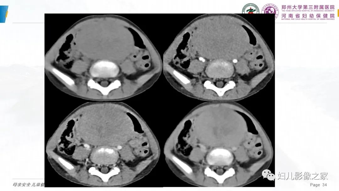 影像PPT - 【PPT】儿童肾母细胞瘤的影像诊断-33