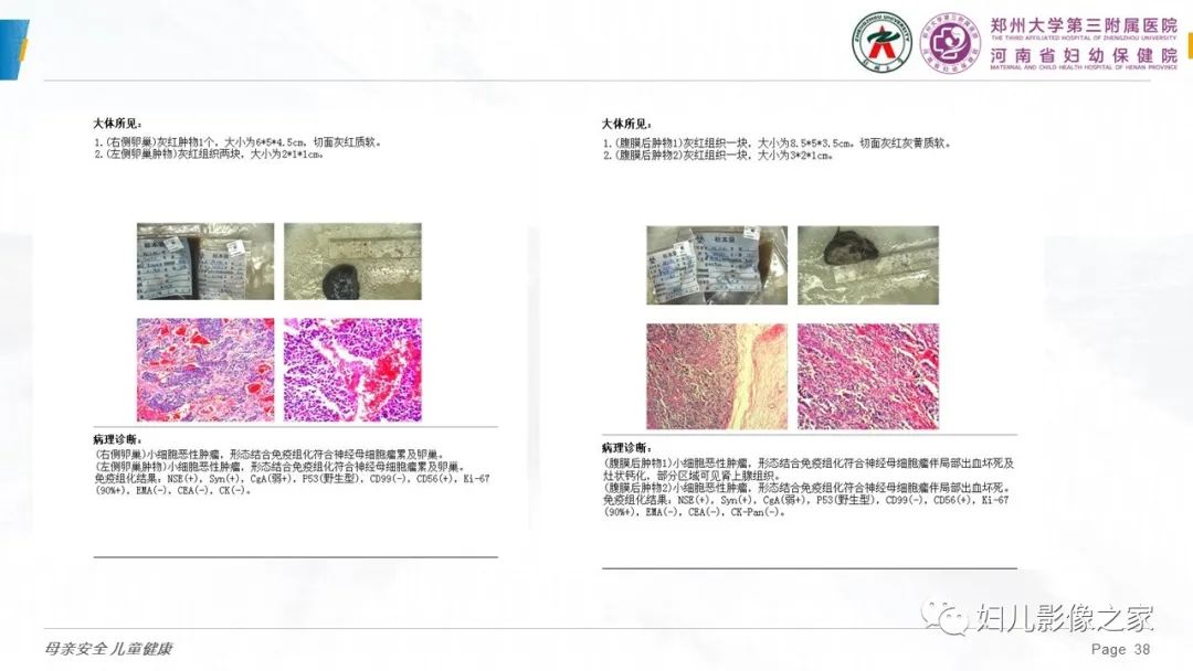 影像PPT - 【PPT】儿童肾母细胞瘤的影像诊断-37
