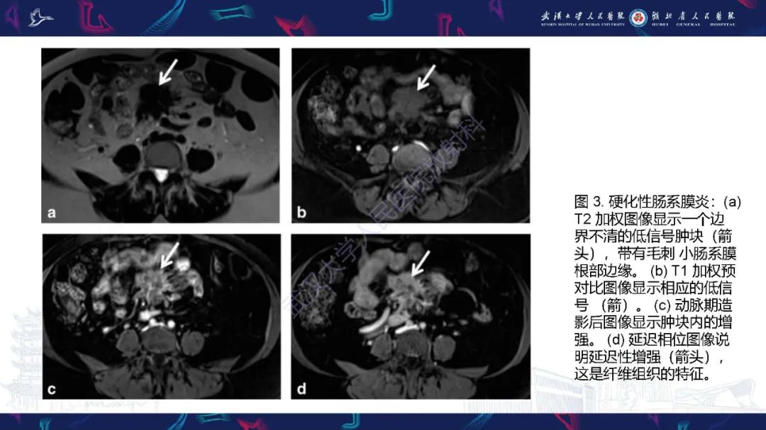 影像PPT - 【PPT】肠系膜实性肿块影像诊断-9