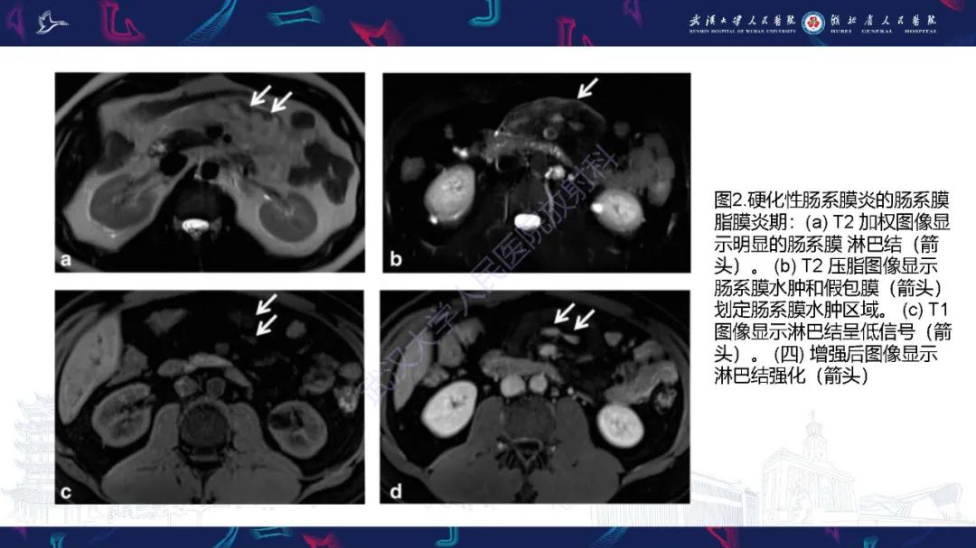 影像PPT - 【PPT】肠系膜实性肿块影像诊断-8