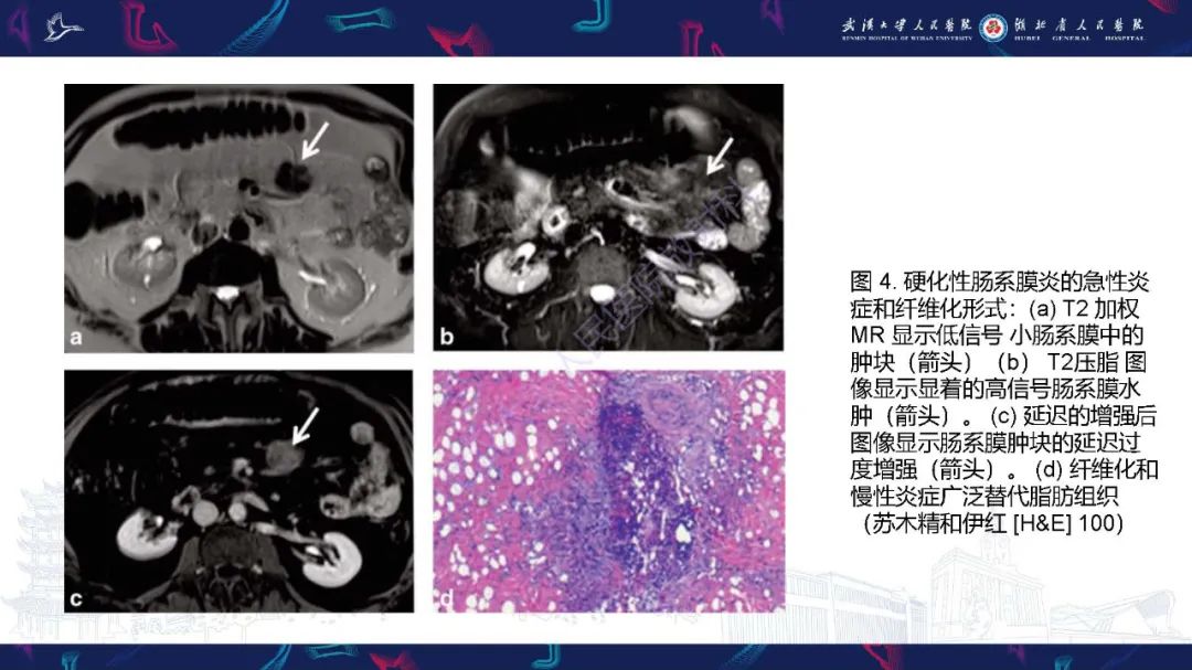 影像PPT - 【PPT】肠系膜实性肿块影像诊断-10