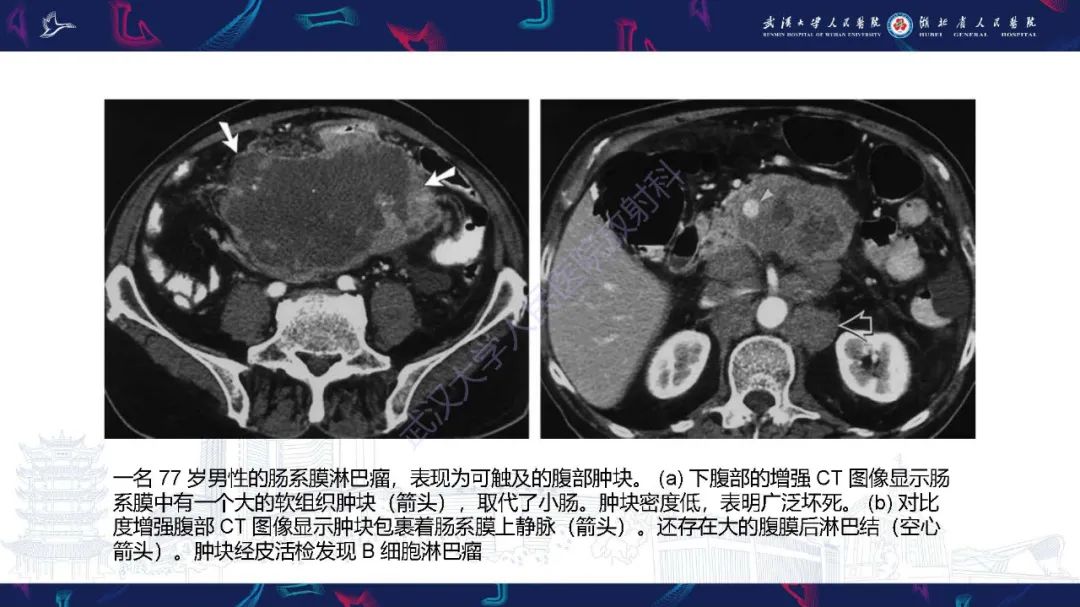 影像PPT - 【PPT】肠系膜实性肿块影像诊断-12
