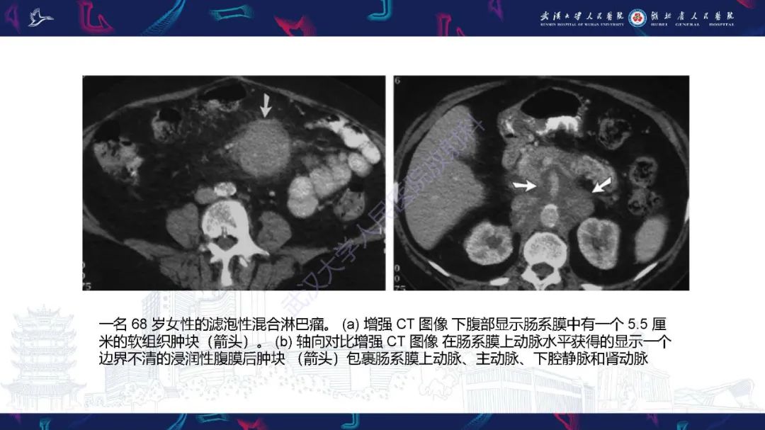 影像PPT - 【PPT】肠系膜实性肿块影像诊断-13
