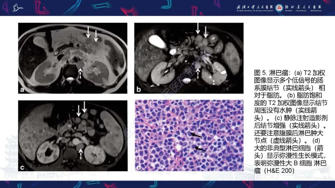 影像PPT - 【PPT】肠系膜实性肿块影像诊断-14