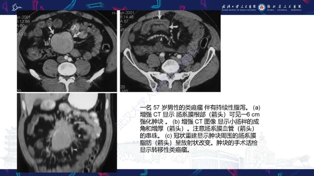 影像PPT - 【PPT】肠系膜实性肿块影像诊断-16