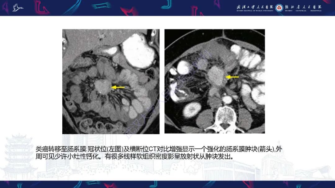 影像PPT - 【PPT】肠系膜实性肿块影像诊断-17