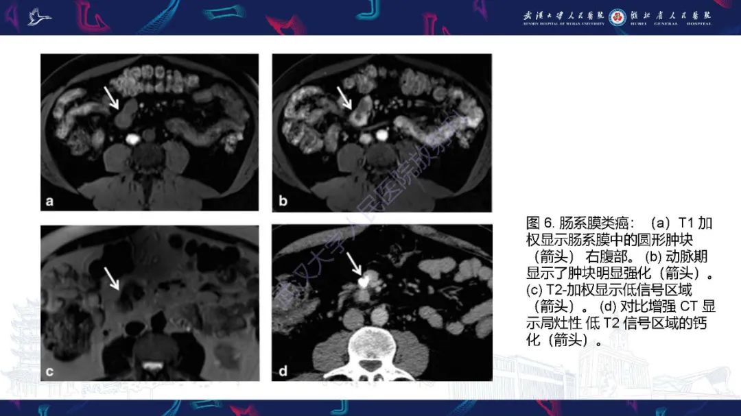 影像PPT - 【PPT】肠系膜实性肿块影像诊断-18