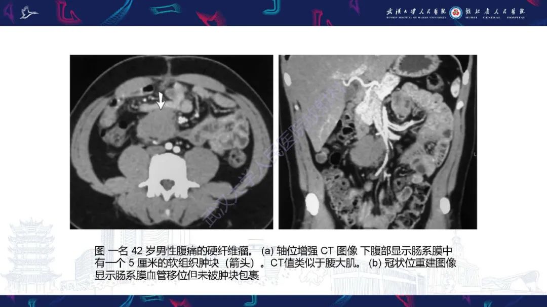影像PPT - 【PPT】肠系膜实性肿块影像诊断-20