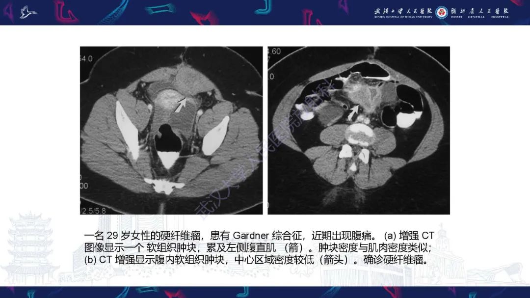 影像PPT - 【PPT】肠系膜实性肿块影像诊断-21