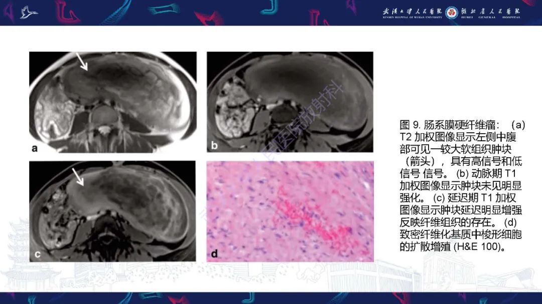 影像PPT - 【PPT】肠系膜实性肿块影像诊断-22