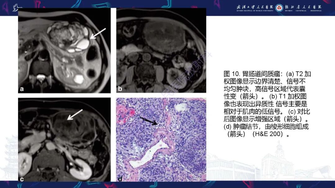 影像PPT - 【PPT】肠系膜实性肿块影像诊断-24