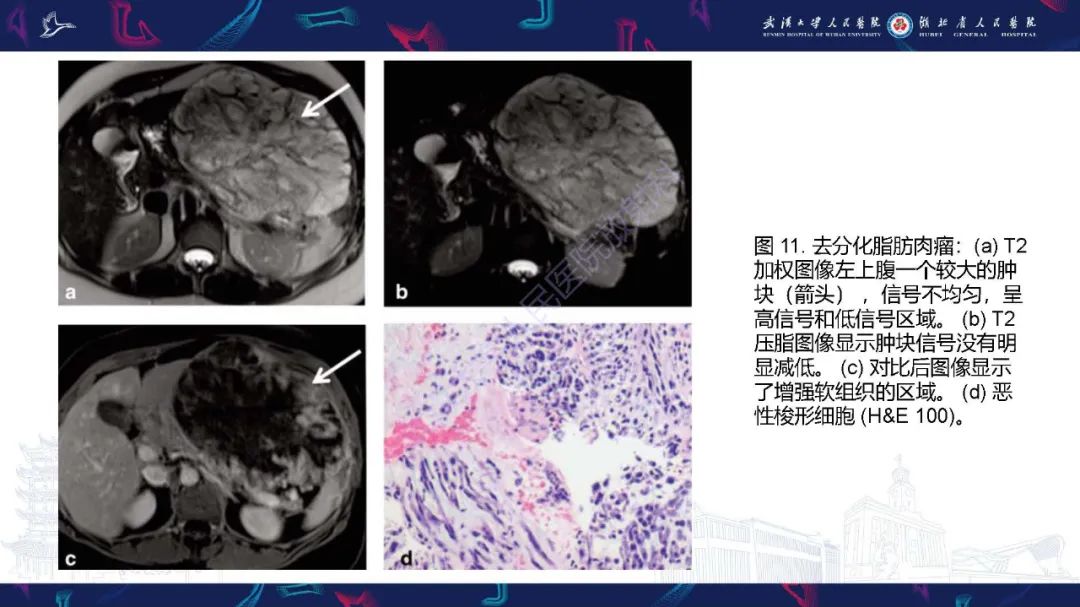 影像PPT - 【PPT】肠系膜实性肿块影像诊断-26