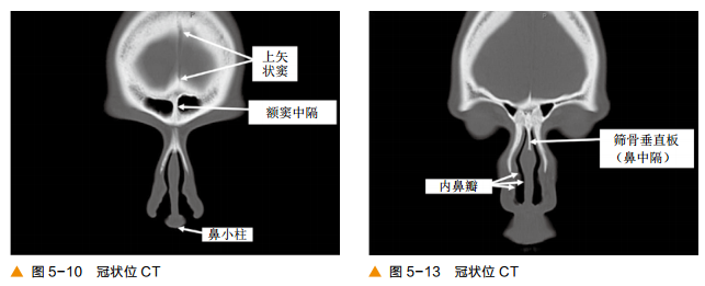 影像PPT - 颅底CT及鼻窦轴冠矢解剖图-7