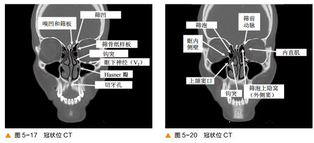 影像PPT - 颅底CT及鼻窦轴冠矢解剖图-11
