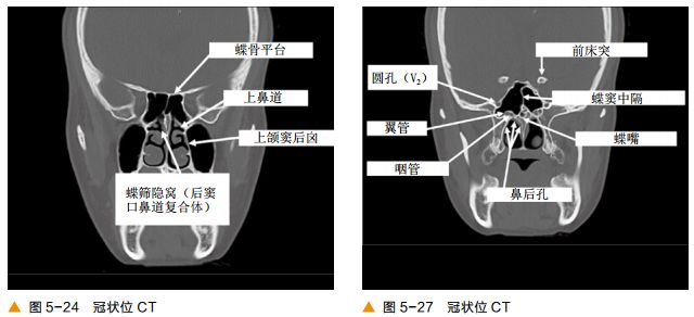 影像PPT - 颅底CT及鼻窦轴冠矢解剖图-15