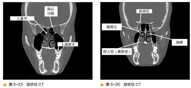 影像PPT - 颅底CT及鼻窦轴冠矢解剖图-14