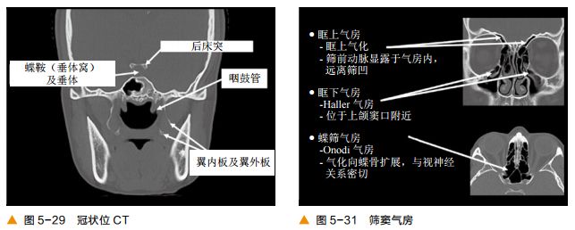 影像PPT - 颅底CT及鼻窦轴冠矢解剖图-17