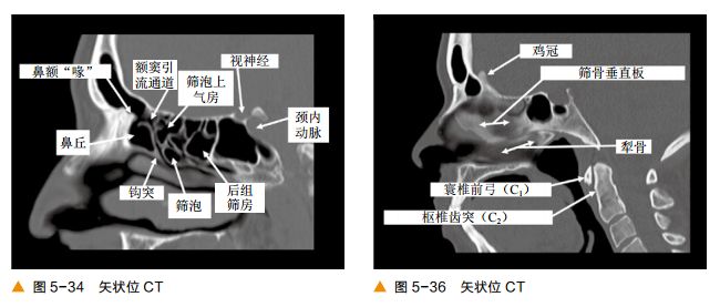 影像PPT - 颅底CT及鼻窦轴冠矢解剖图-20