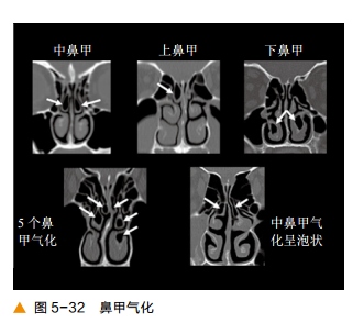 影像PPT - 颅底CT及鼻窦轴冠矢解剖图-18