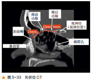 影像PPT - 颅底CT及鼻窦轴冠矢解剖图-19