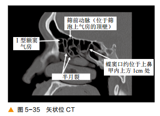 影像PPT - 颅底CT及鼻窦轴冠矢解剖图-21