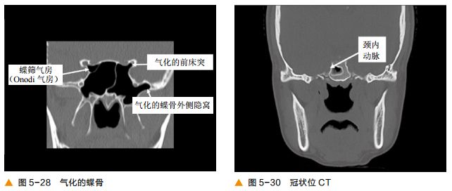 影像PPT - 颅底CT及鼻窦轴冠矢解剖图-16