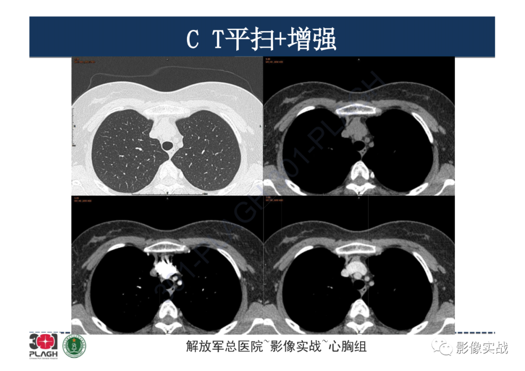 影像PPT - 【病例】纵隔畸胎瘤1例CT影像-4
