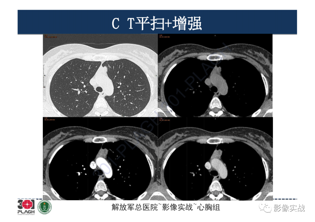 影像PPT - 【病例】纵隔畸胎瘤1例CT影像-5