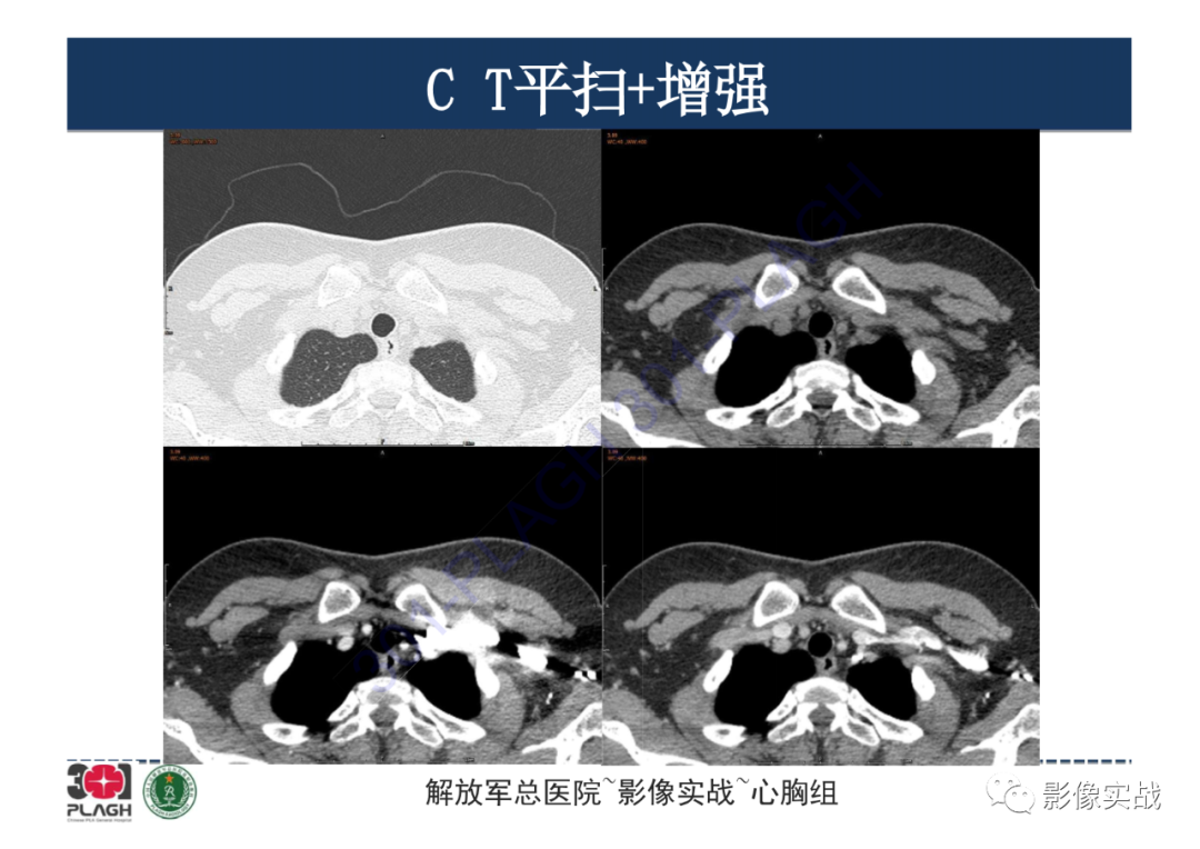 影像PPT - 【病例】纵隔畸胎瘤1例CT影像-3