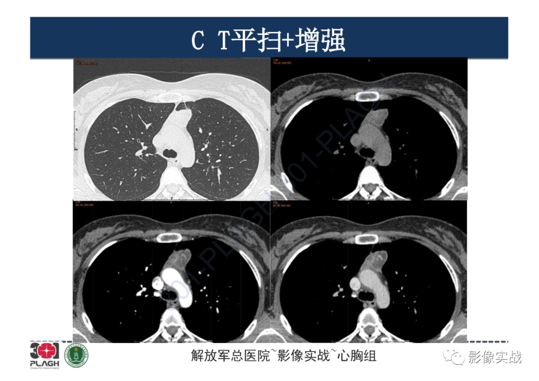 影像PPT - 【病例】纵隔畸胎瘤1例CT影像-6