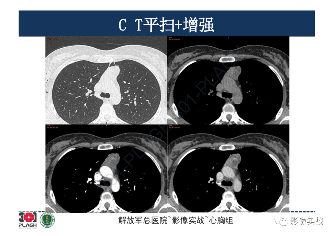 影像PPT - 【病例】纵隔畸胎瘤1例CT影像-7