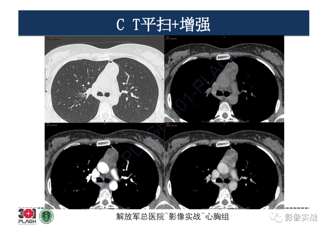 影像PPT - 【病例】纵隔畸胎瘤1例CT影像-8