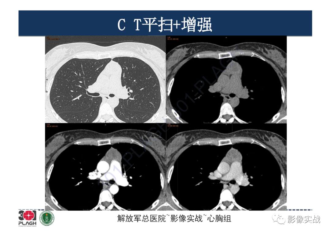 影像PPT - 【病例】纵隔畸胎瘤1例CT影像-9