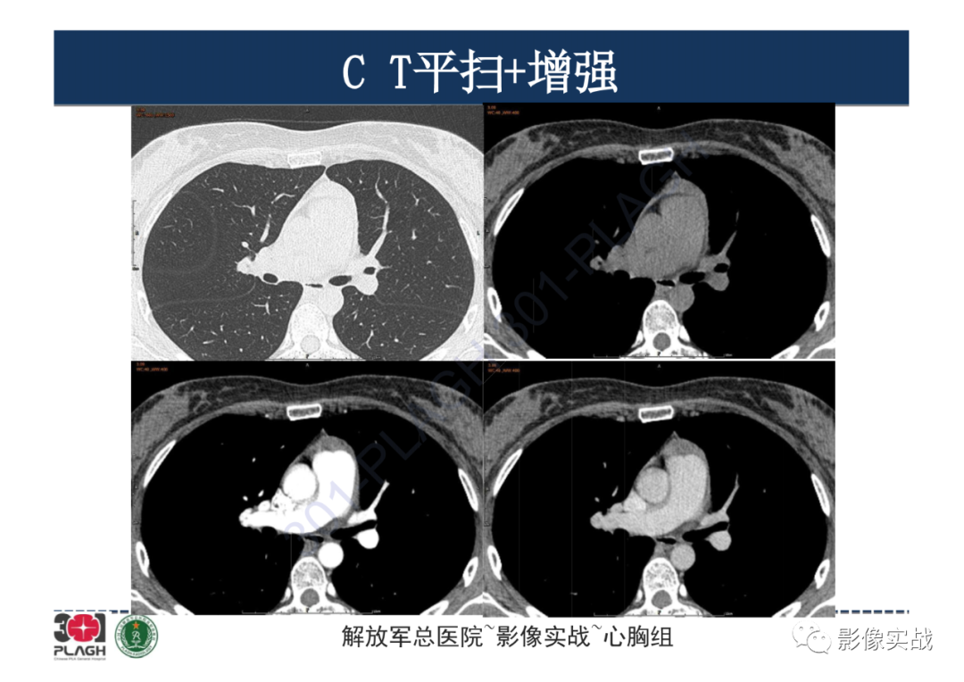 影像PPT - 【病例】纵隔畸胎瘤1例CT影像-10