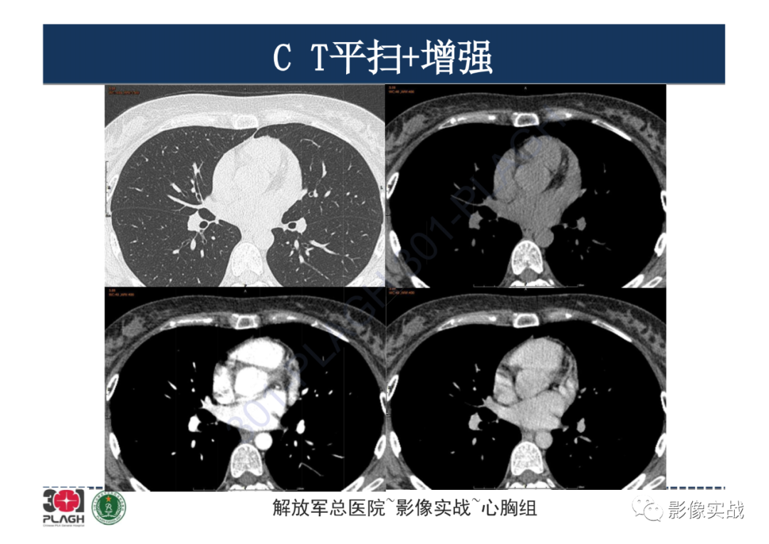 影像PPT - 【病例】纵隔畸胎瘤1例CT影像-11