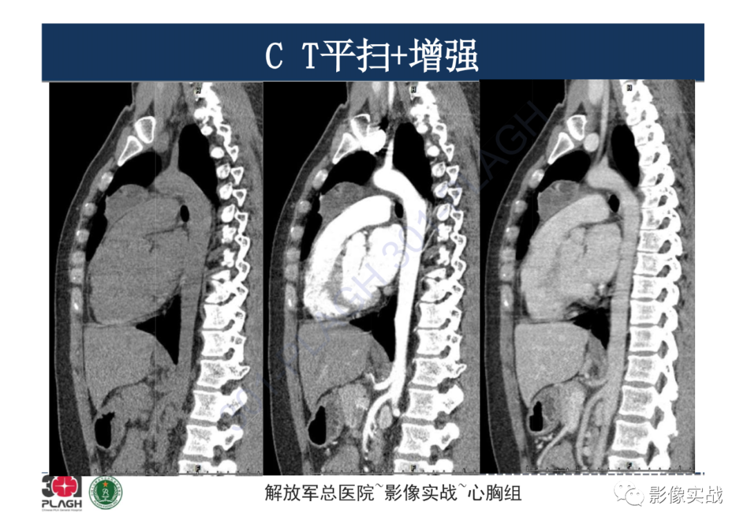 影像PPT - 【病例】纵隔畸胎瘤1例CT影像-12
