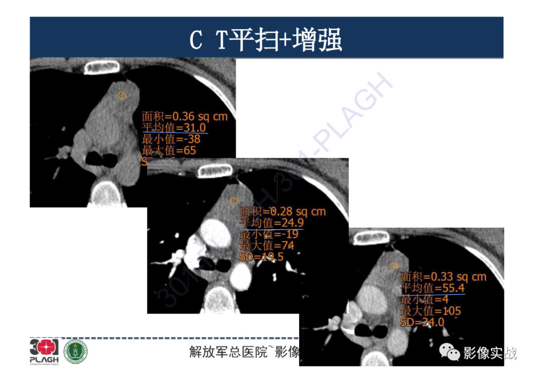 影像PPT - 【病例】纵隔畸胎瘤1例CT影像-13