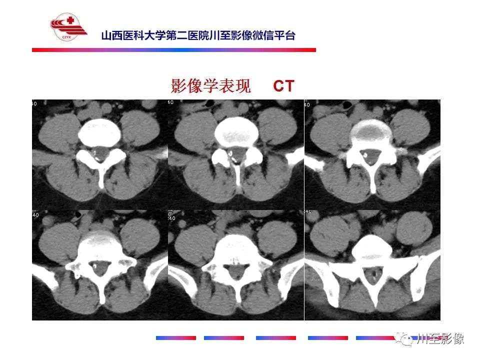 影像PPT - 【PPT】椎管内畸胎瘤-4 影像PPT - 【PPT】椎管内畸胎瘤-4