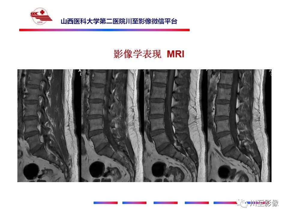 影像PPT - 【PPT】椎管内畸胎瘤-6 影像PPT - 【PPT】椎管内畸胎瘤-6