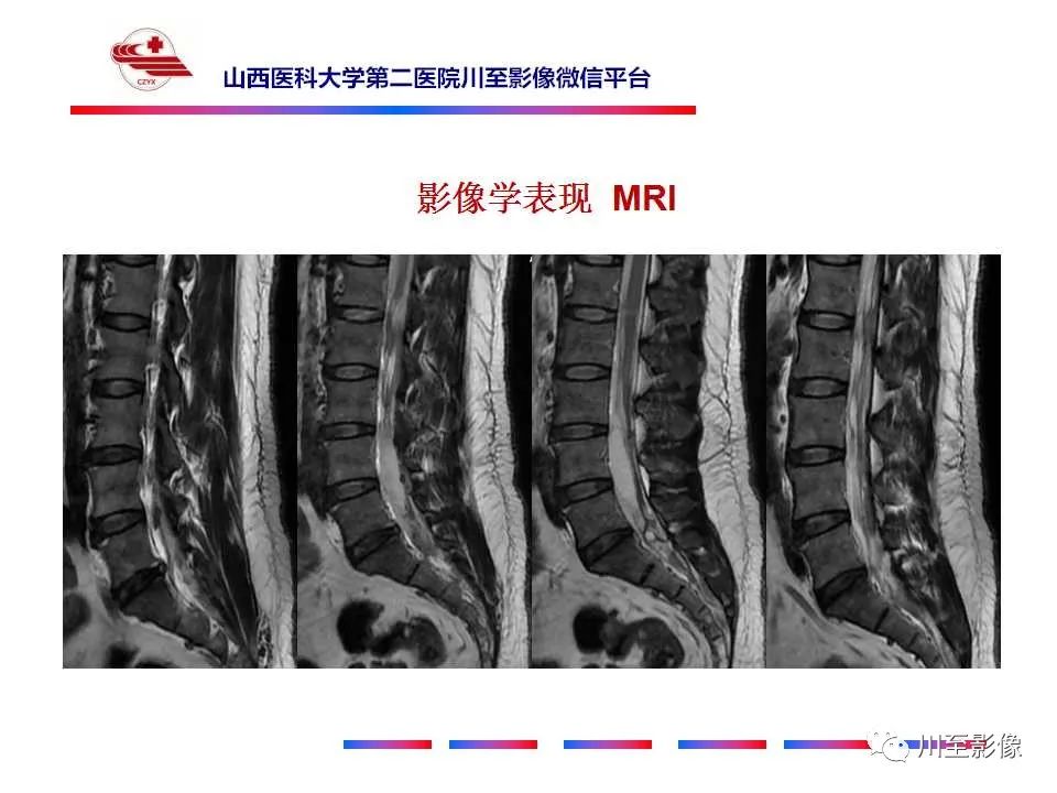 影像PPT - 【PPT】椎管内畸胎瘤-7 影像PPT - 【PPT】椎管内畸胎瘤-7