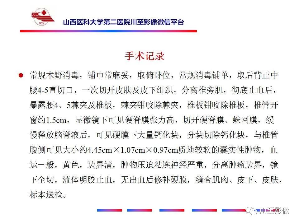 影像PPT - 【PPT】椎管内畸胎瘤-11 影像PPT - 【PPT】椎管内畸胎瘤-11